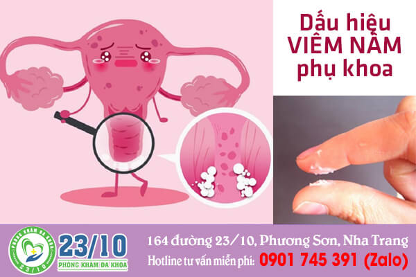 Dấu hiệu viêm nấm phụ khoa