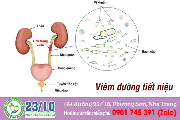 Dấu hiệu viêm đường tiết niệu